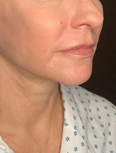 Patient #13826: Facelift After Image
