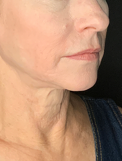 Patient #13826: Facelift Before Image