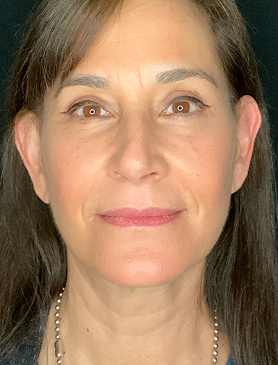 Patient #28144: Facelift After Image