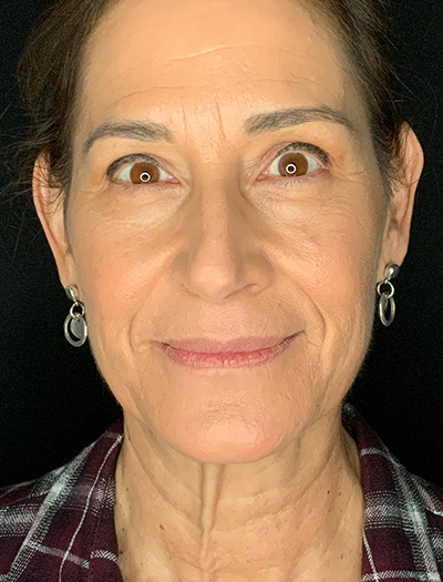Patient #28144: Facelift Before Image