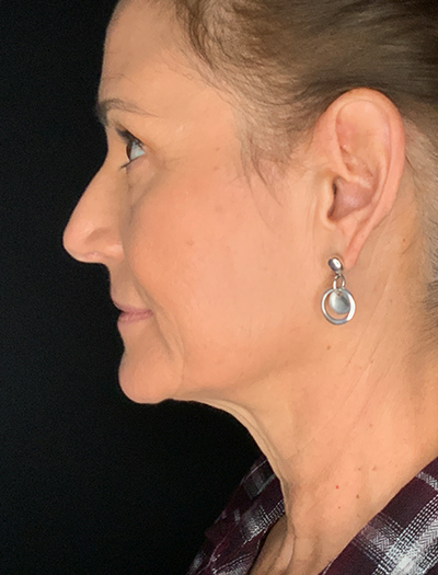 Patient #28144: Facelift Before Image