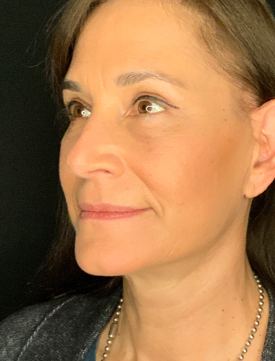 Patient #28144: Facelift After Image