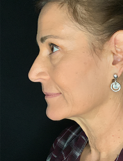 Patient #28144: Facelift Before Image