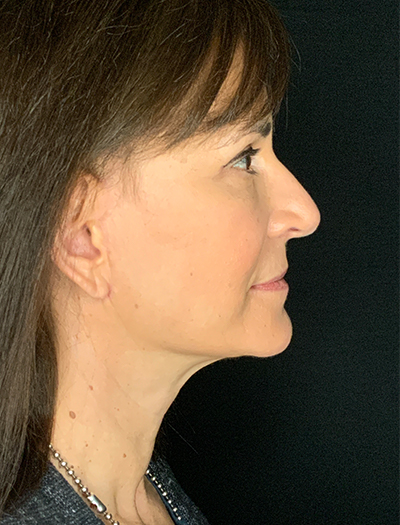 Patient #28144: Facelift After Image