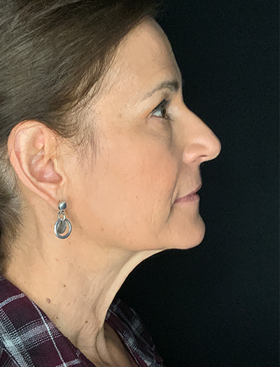 Patient #28144: Facelift Before Image