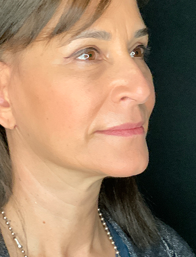 Patient #28144: Facelift After Image