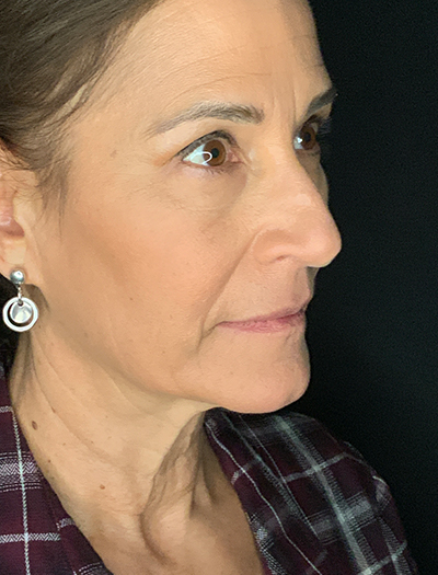 Patient #28144: Facelift Before Image