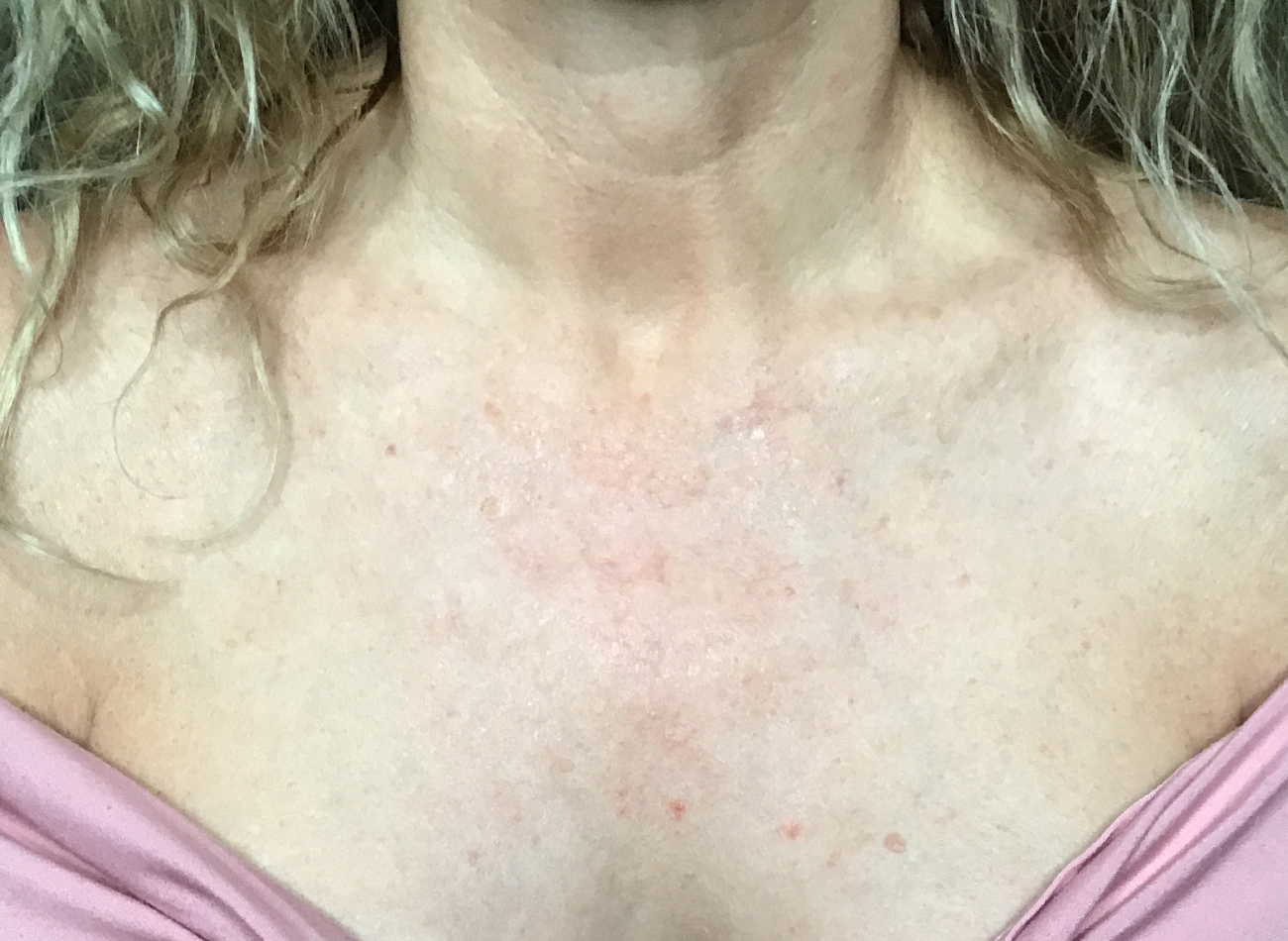 Patient #11433: IPL After Image