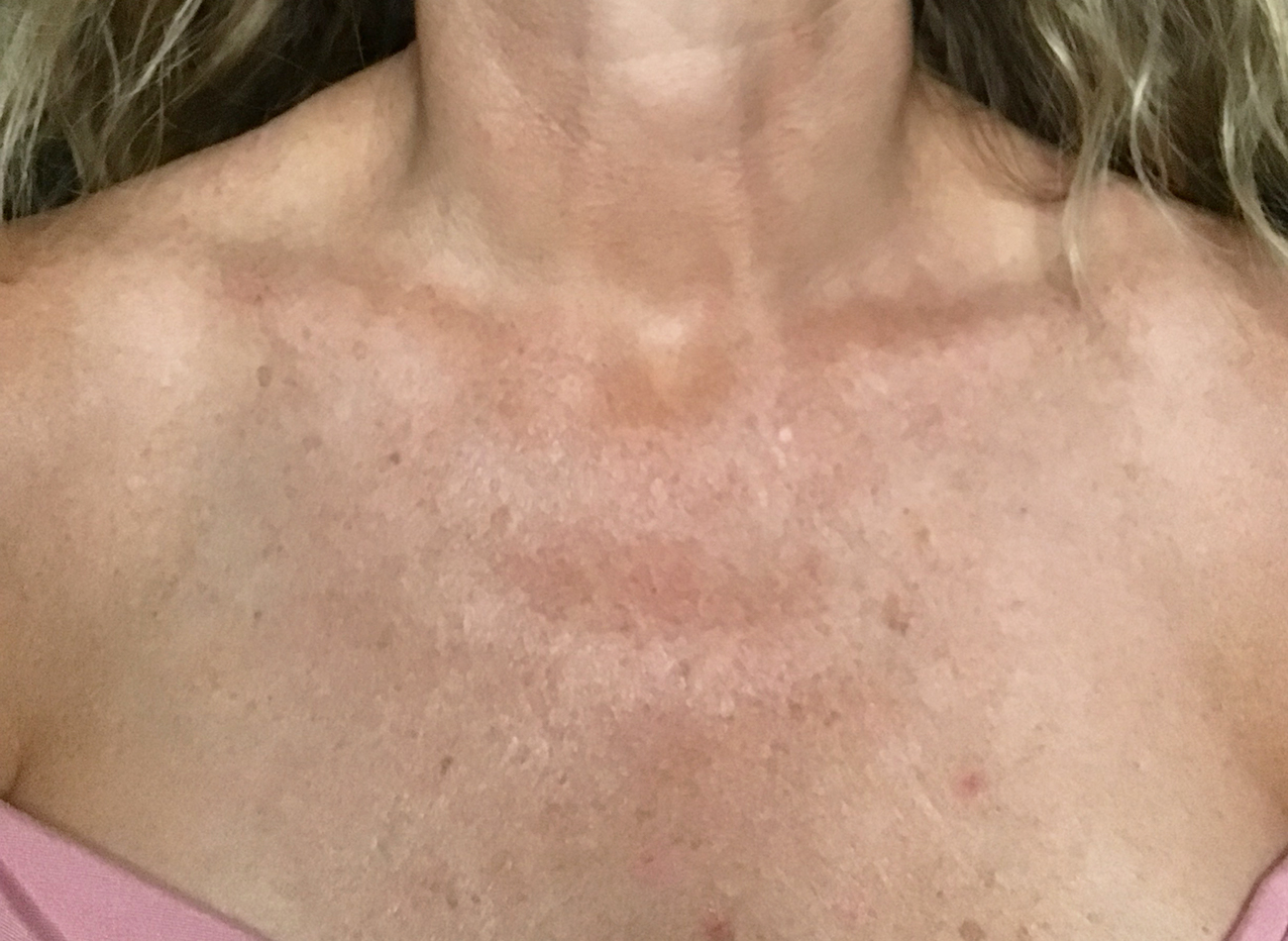 Patient #11433: IPL Before Image