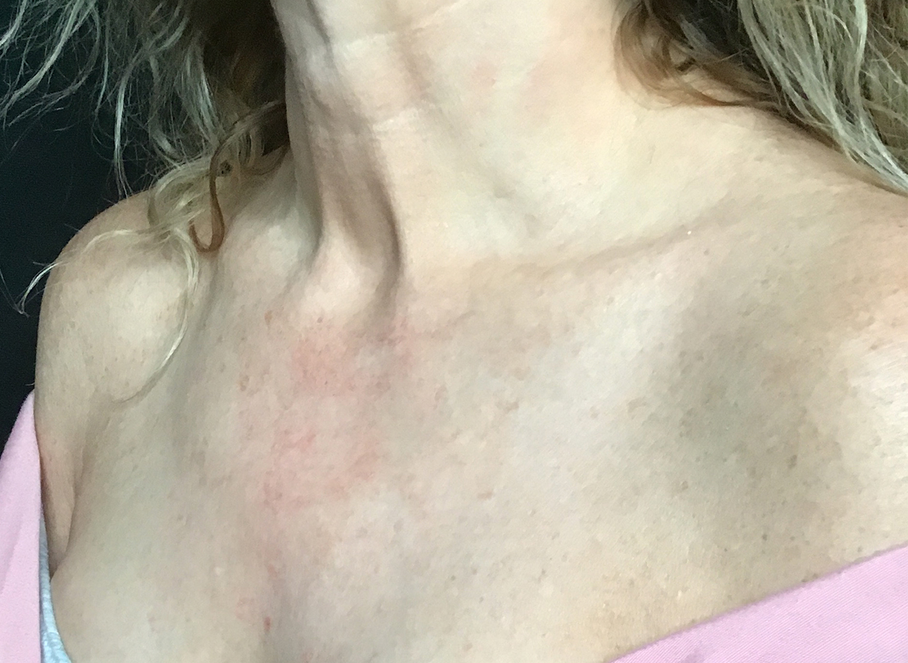 Patient #11433: IPL After Image