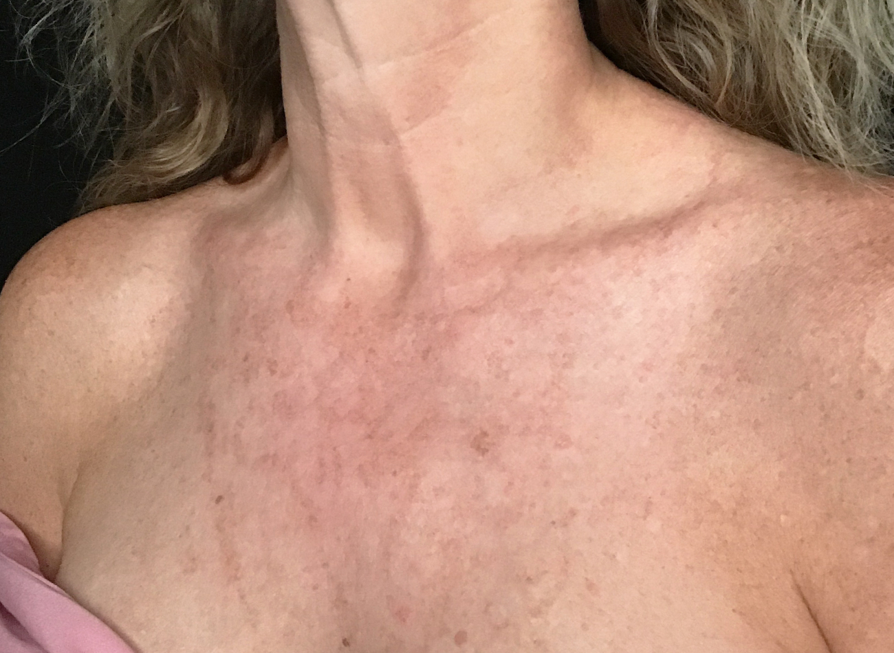 Patient #11433: IPL Before Image