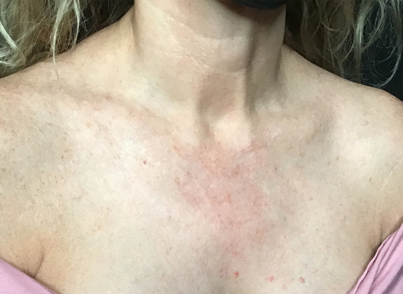 Patient #11433: IPL After Image