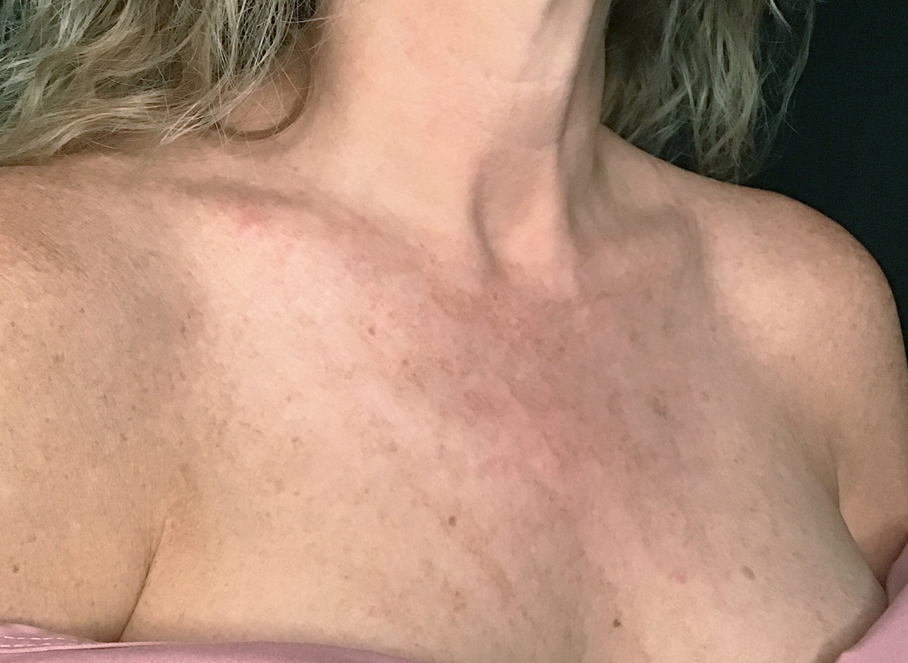 Patient #11433: IPL Before Image