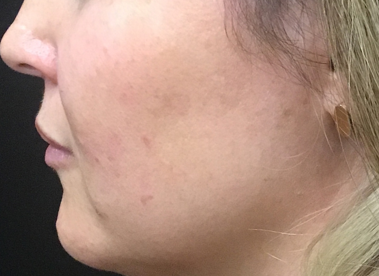 Patient #42011: IPL After Image