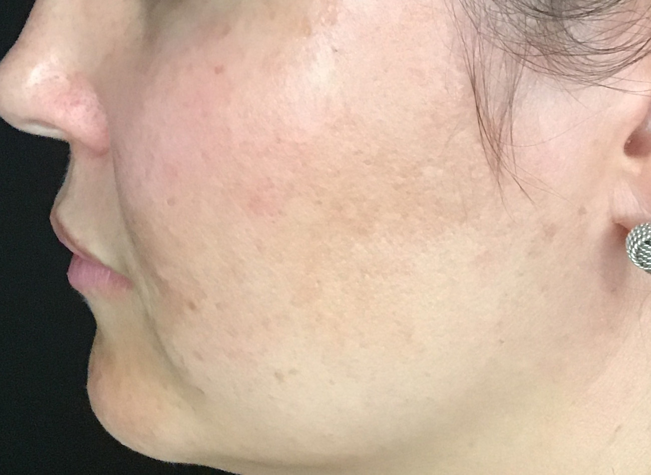 Patient #42011: IPL Before Image