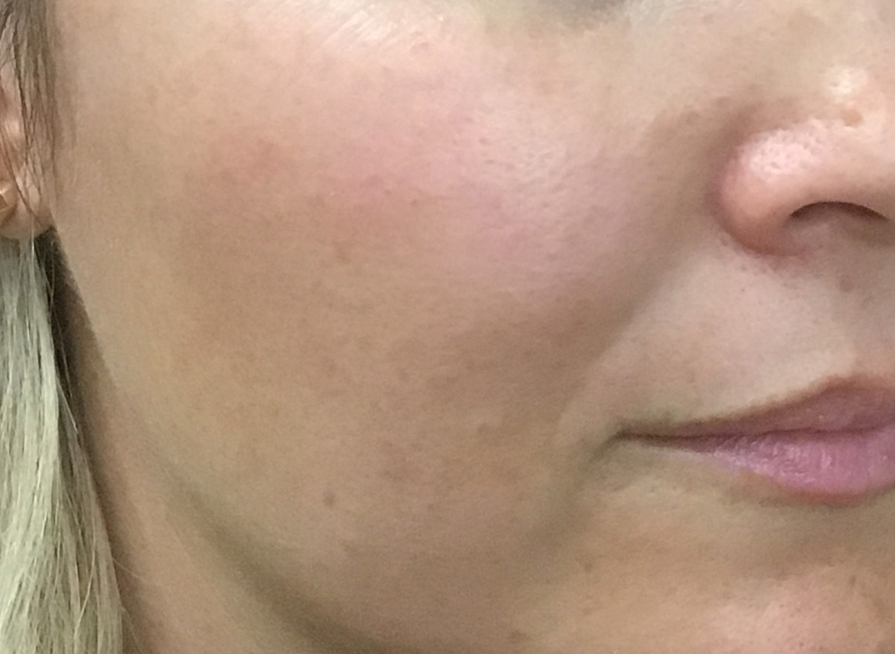 Patient #42011: IPL After Image