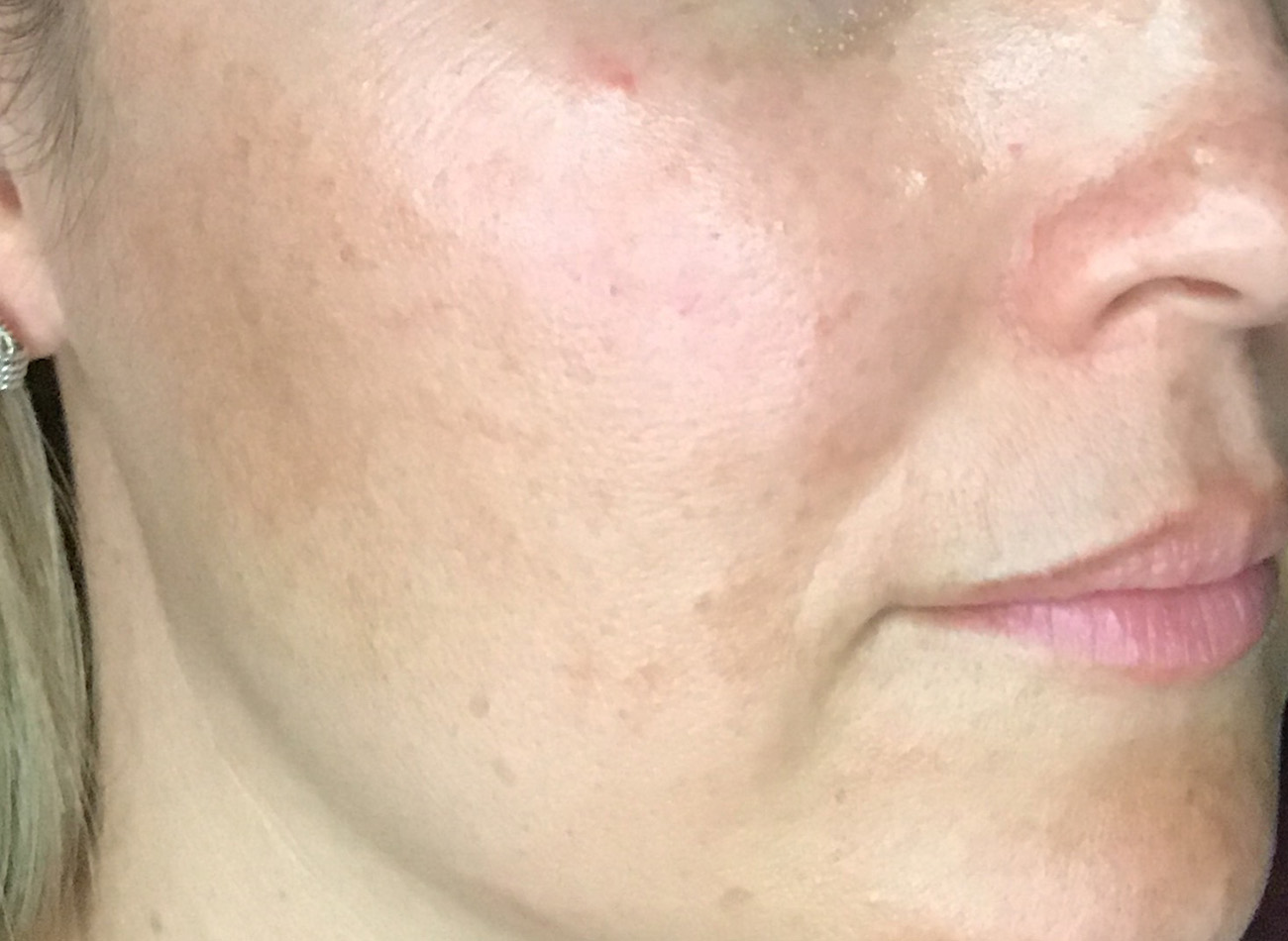 Patient #42011: IPL Before Image