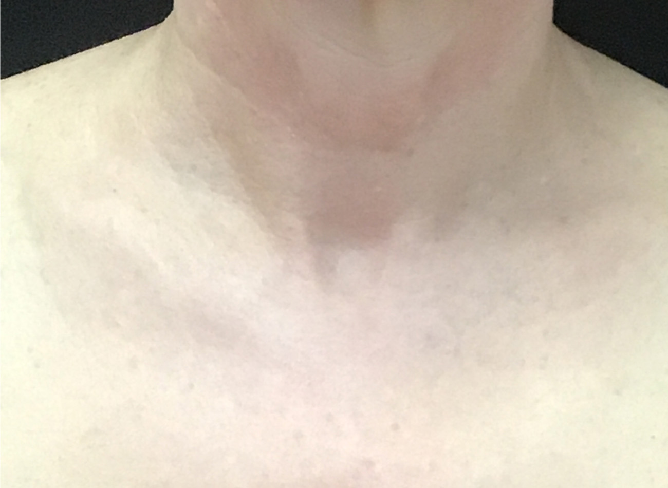 Patient #82977: IPL After Image