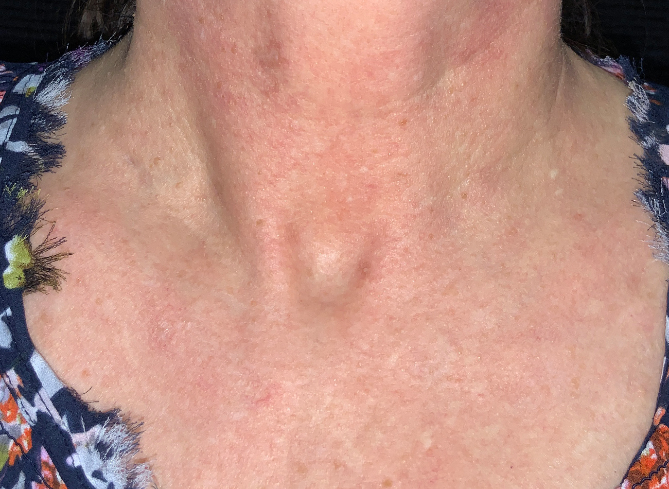 Patient #82977: IPL Before Image