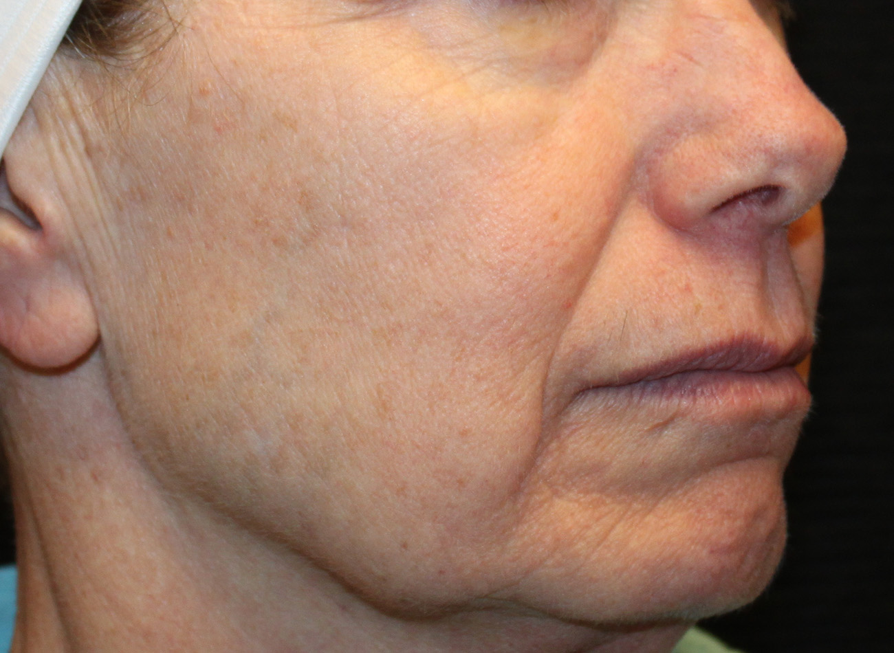 Patient #25239: IPL Before Image