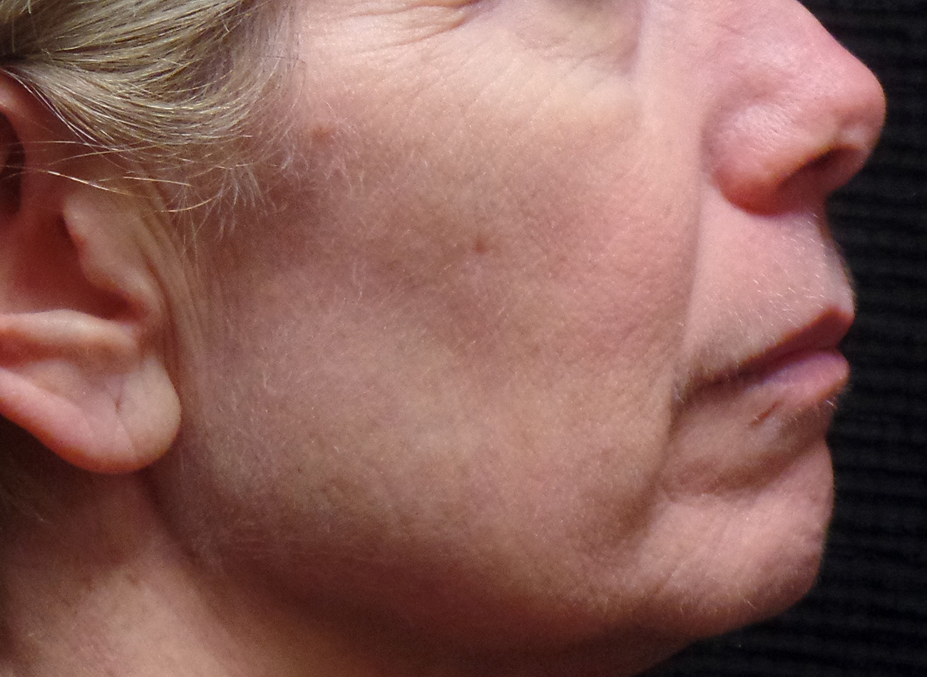 Patient #25239: IPL After Image