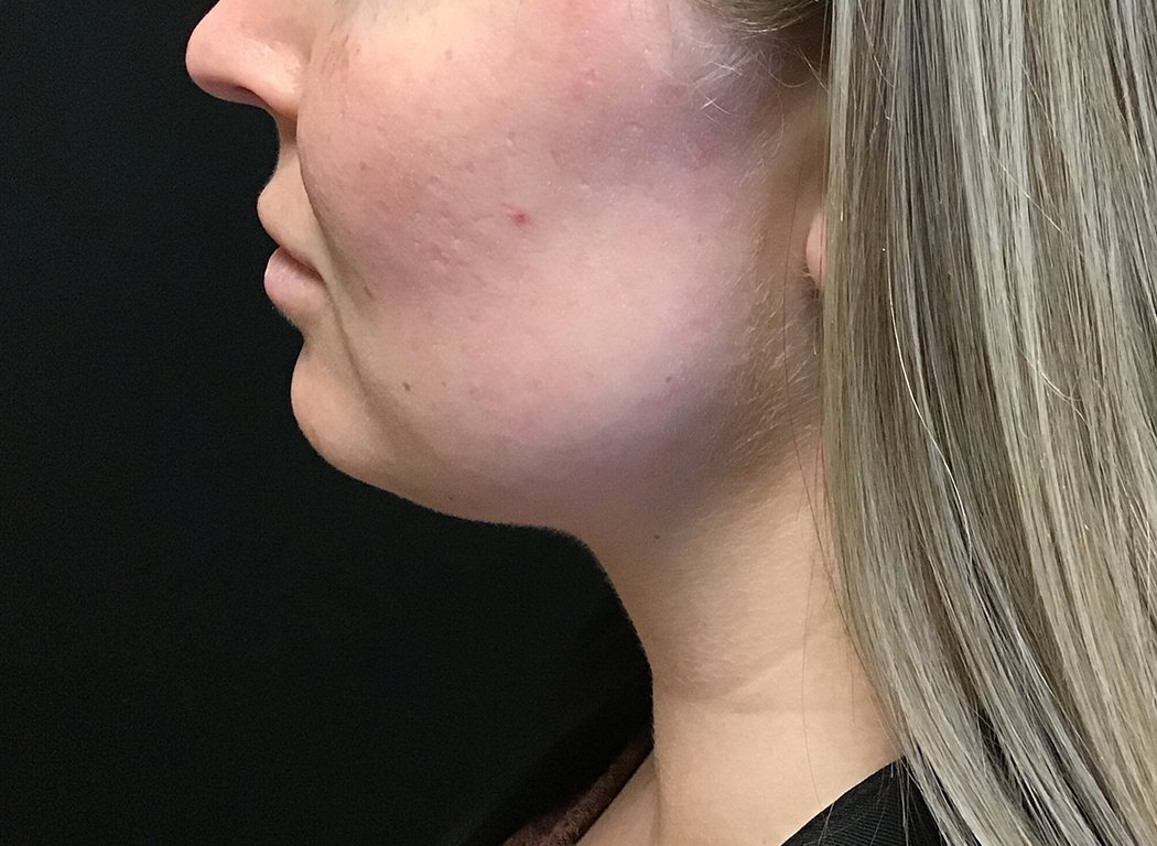 Patient #80222-3: Kybella After Image