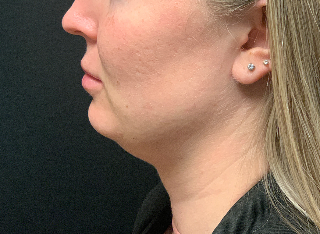Patient #80222-3: Kybella Before Image