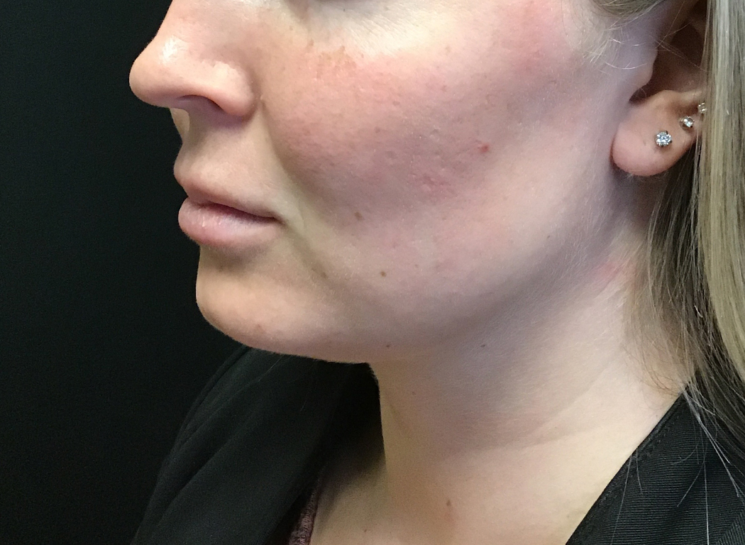 Patient #80222-3: Kybella After Image