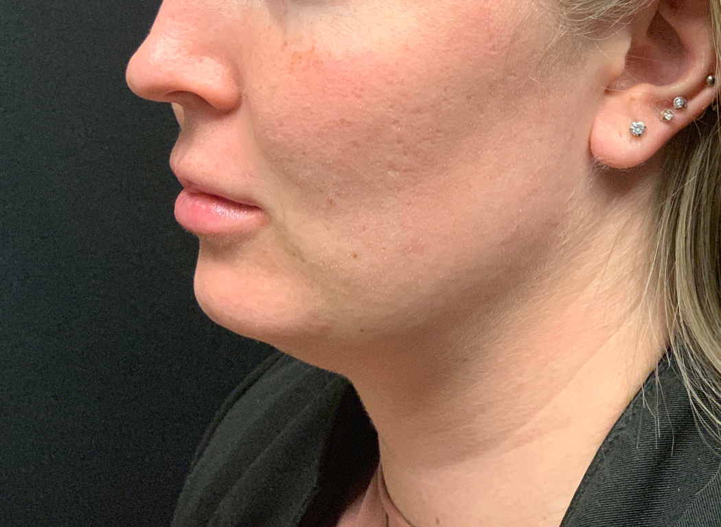 Patient #80222-3: Kybella Before Image