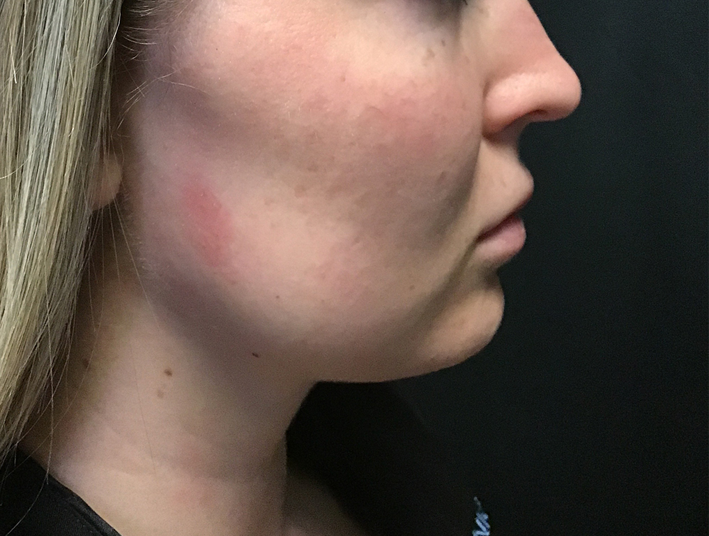 Patient #80222-3: Kybella After Image