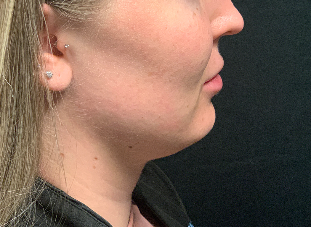 Patient #80222-3: Kybella Before Image