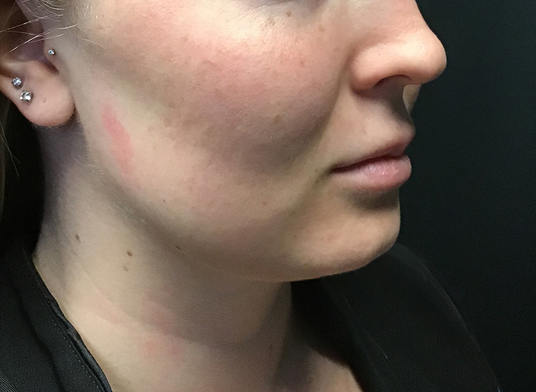 Patient #80222-3: Kybella After Image