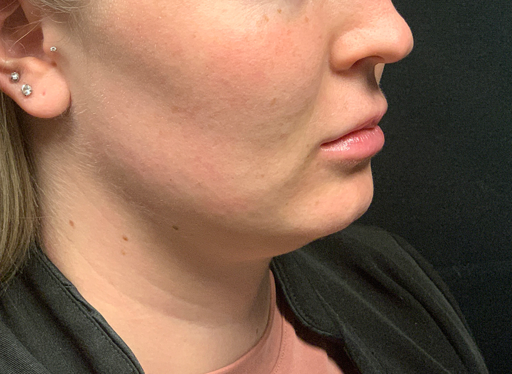 Patient #80222-3: Kybella Before Image