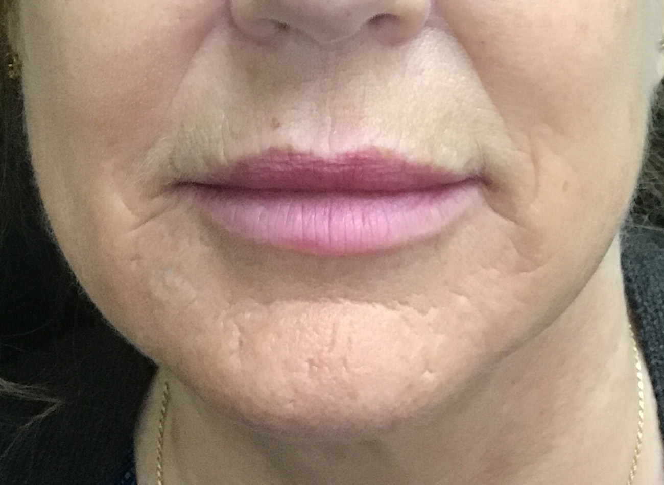 Patient #60168: Juvéderm After Image