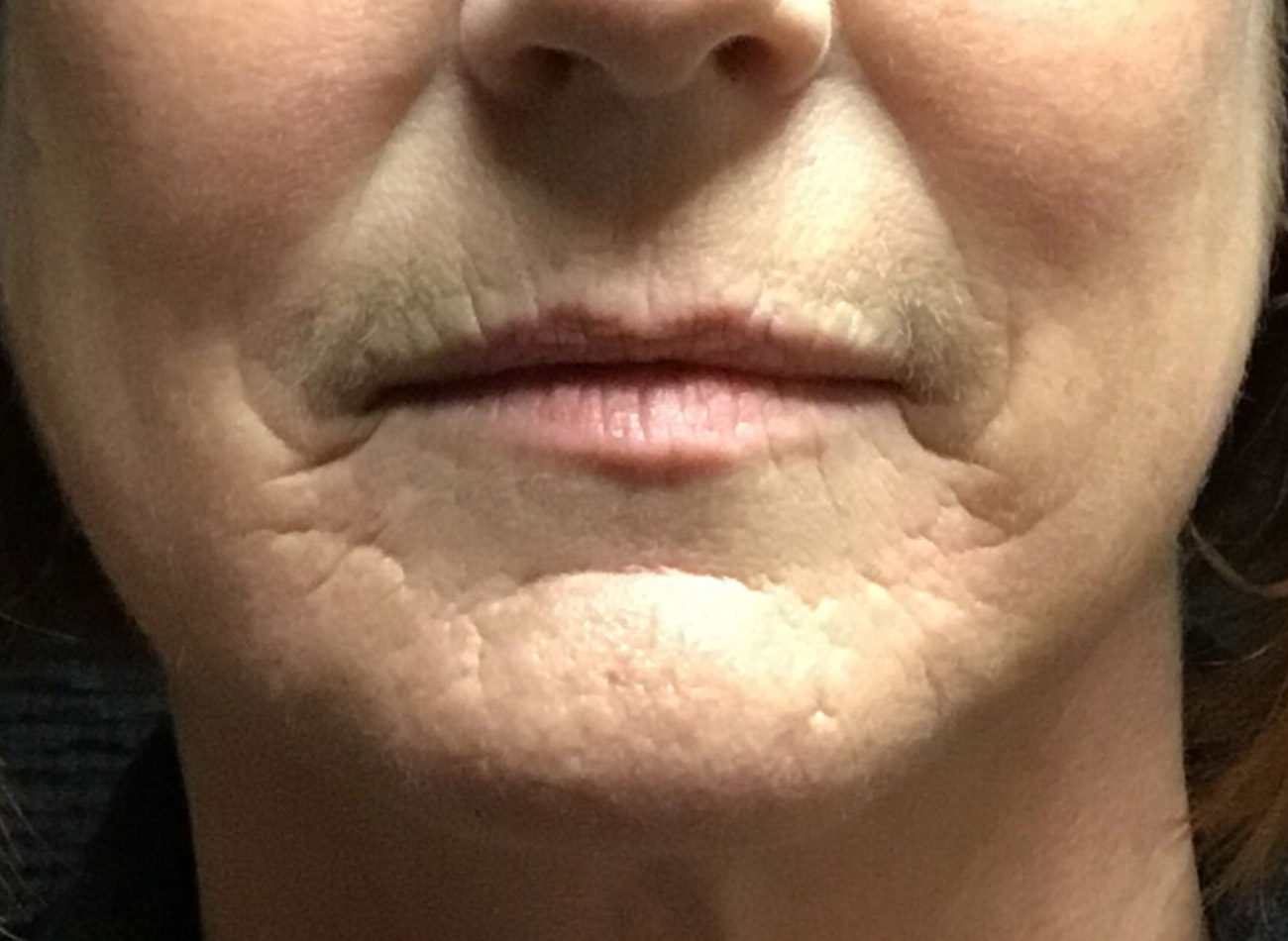 Patient #60168: Juvéderm Before Image
