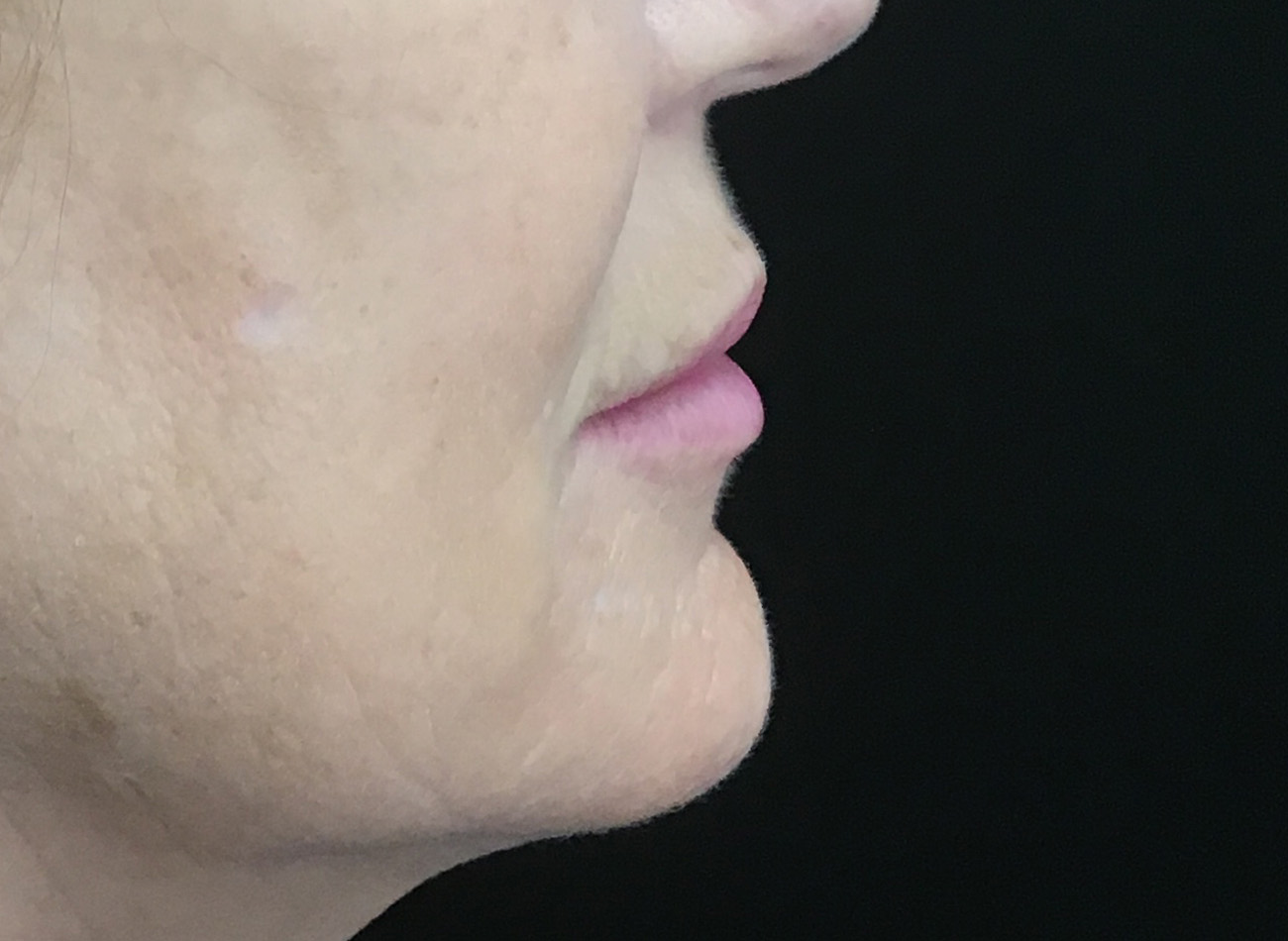 Patient #60168: Juvéderm After Image