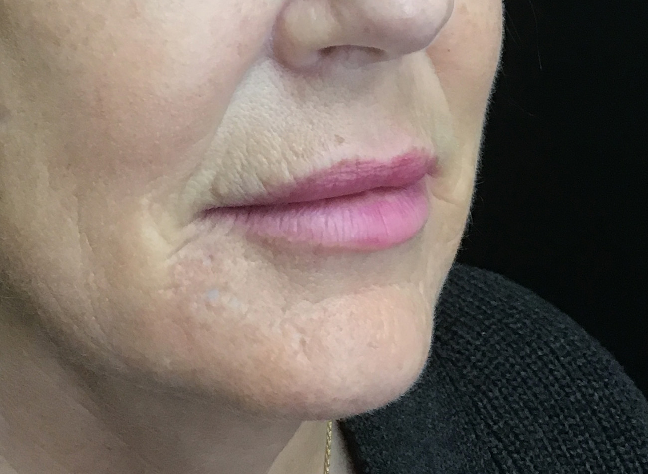 Patient #60168: Juvéderm After Image