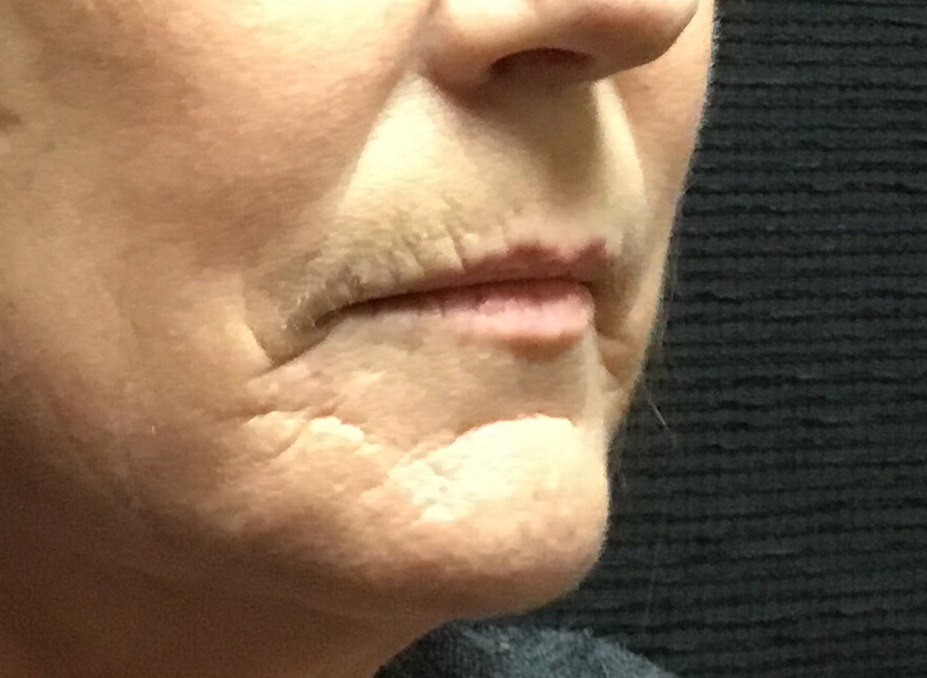 Patient #60168: Juvéderm Before Image