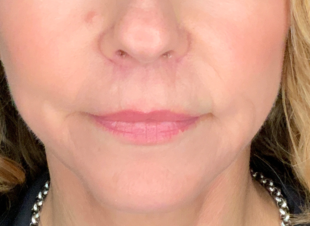 Patient #61136-2: Lip Lift After Image