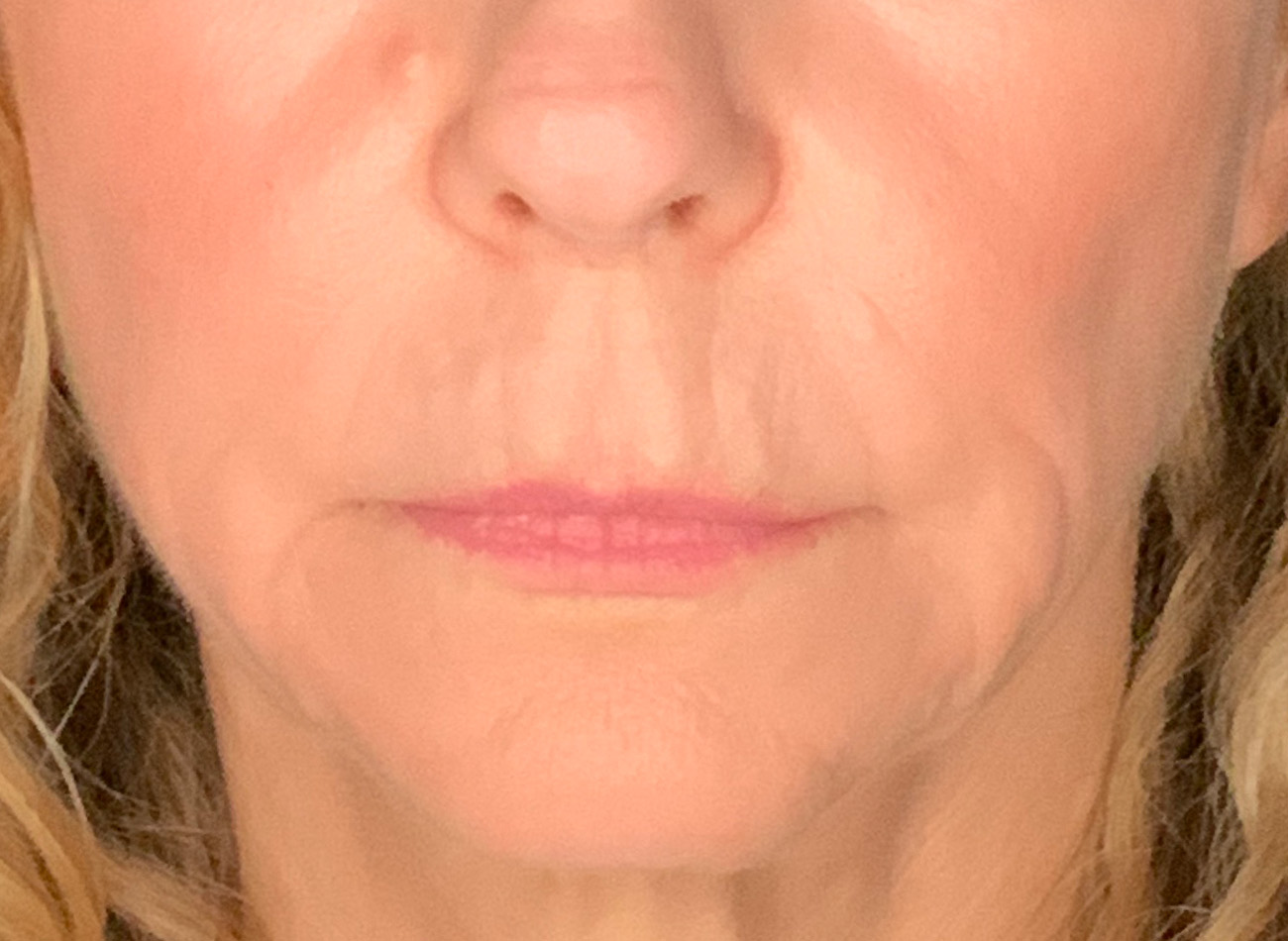 Patient #61136-2: Lip Lift Before Image