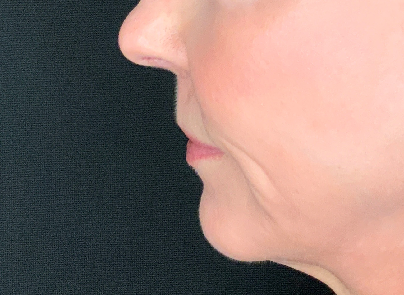 Patient #61136-2: Lip Lift After Image