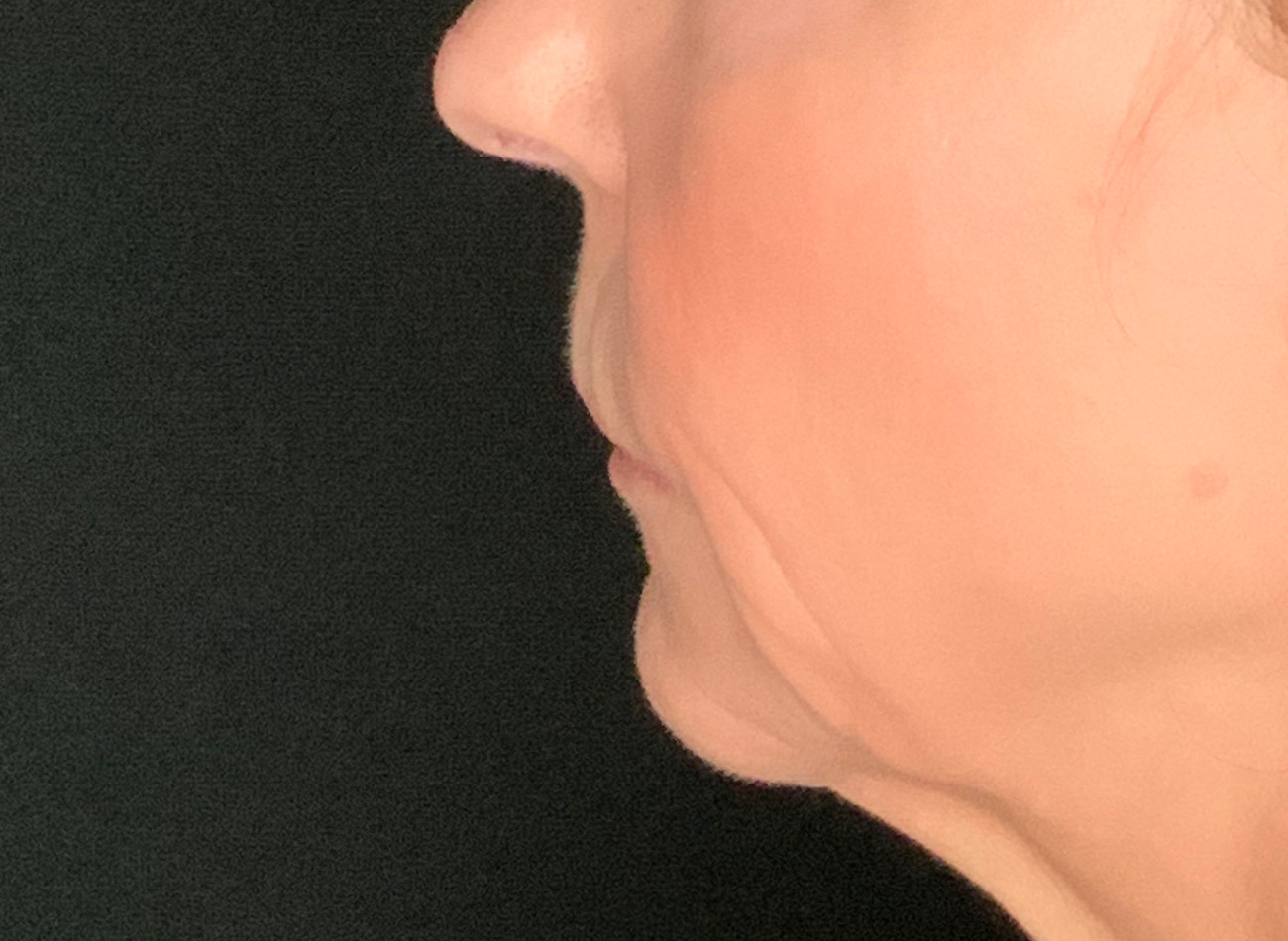 Patient #61136-2: Lip Lift Before Image