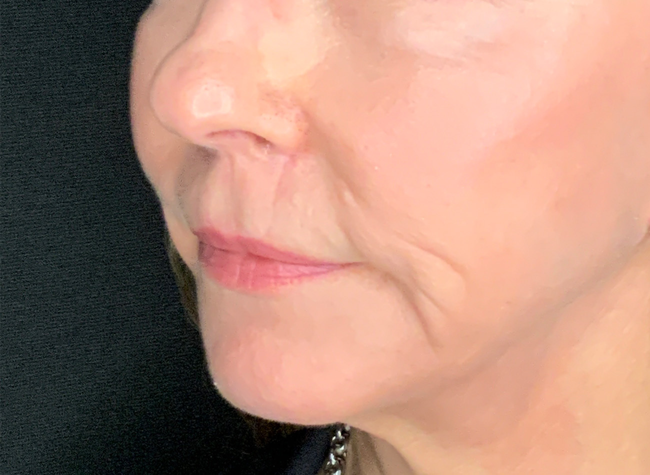 Patient #61136-2: Lip Lift After Image