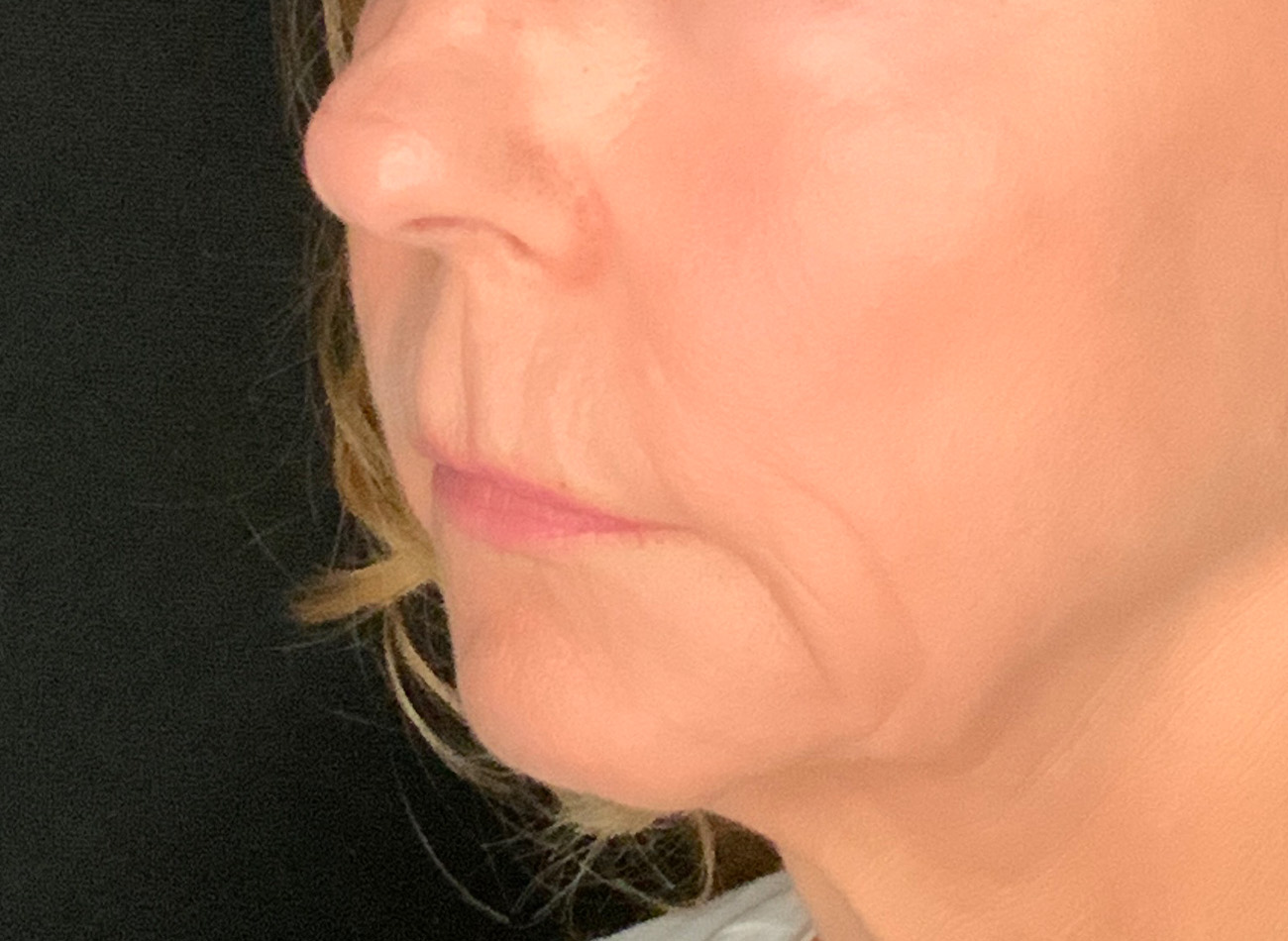 Patient #61136-2: Lip Lift Before Image