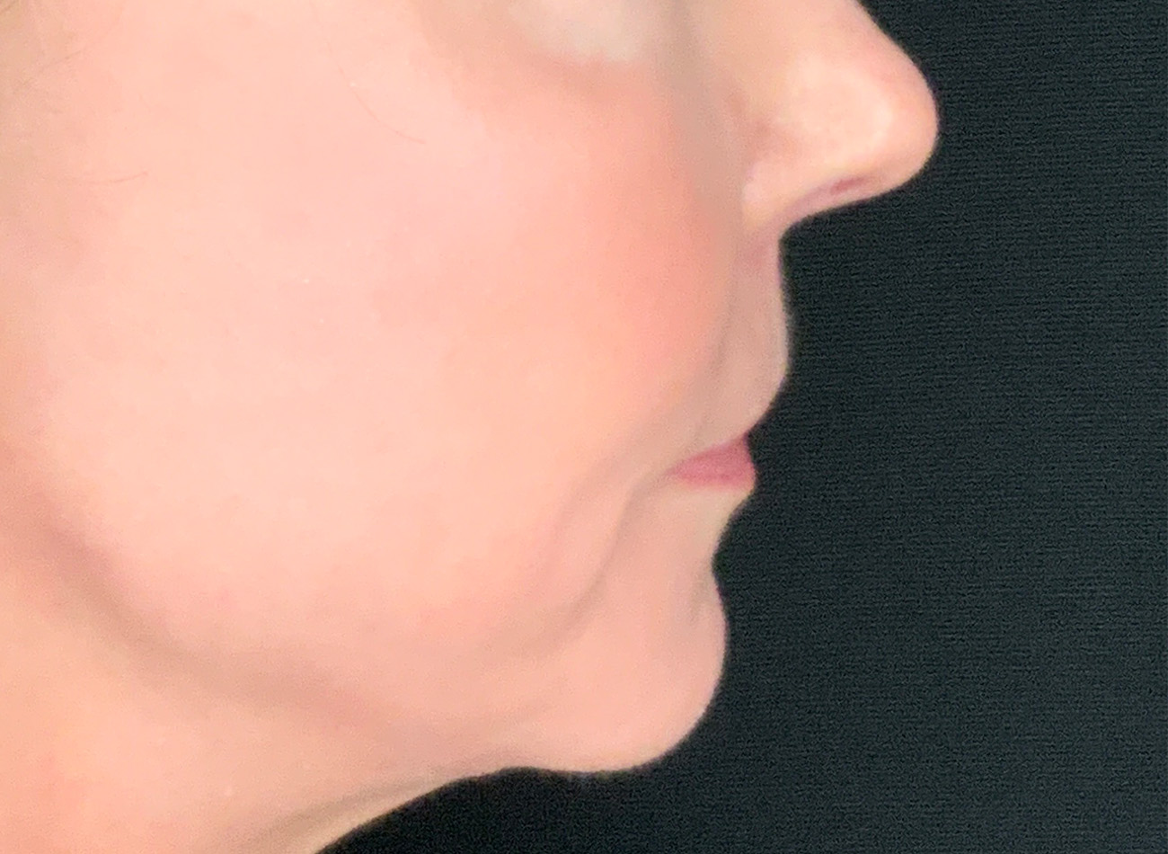 Patient #61136-2: Lip Lift After Image