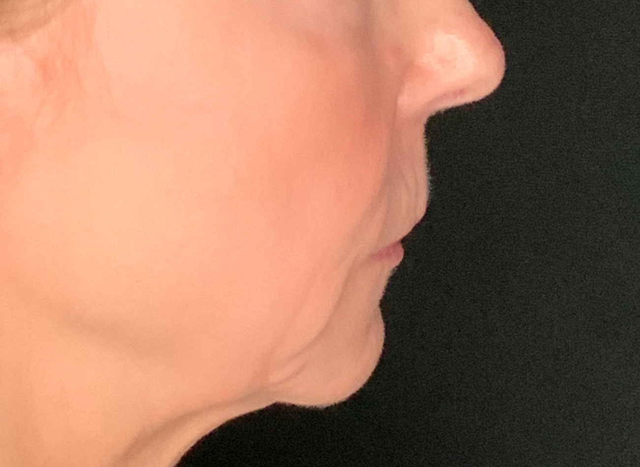 Patient #61136-2: Lip Lift Before Image