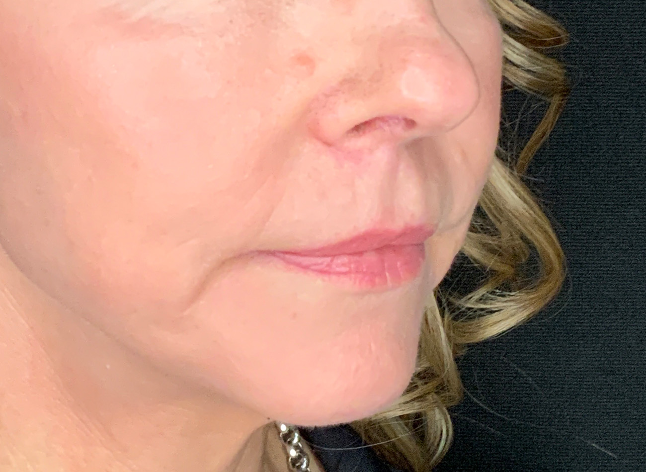 Patient #61136-2: Lip Lift After Image