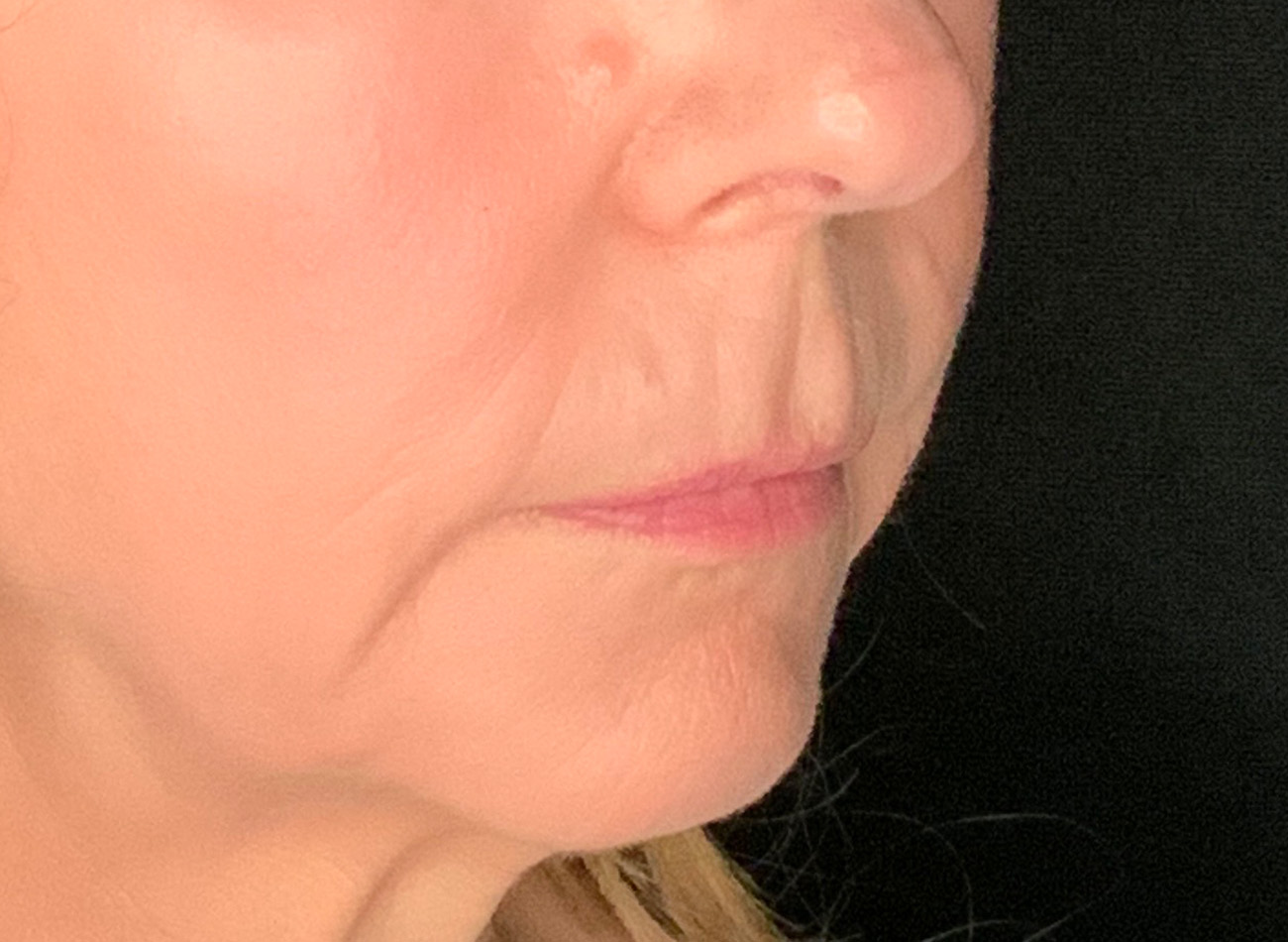 Patient #61136-2: Lip Lift Before Image