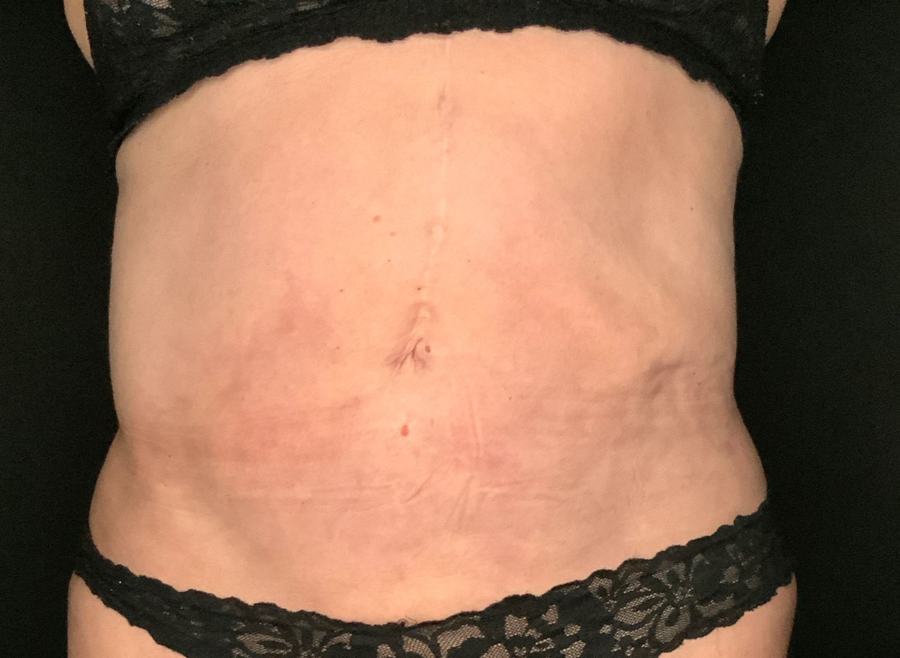 Patient #49717: Liposuction After Image