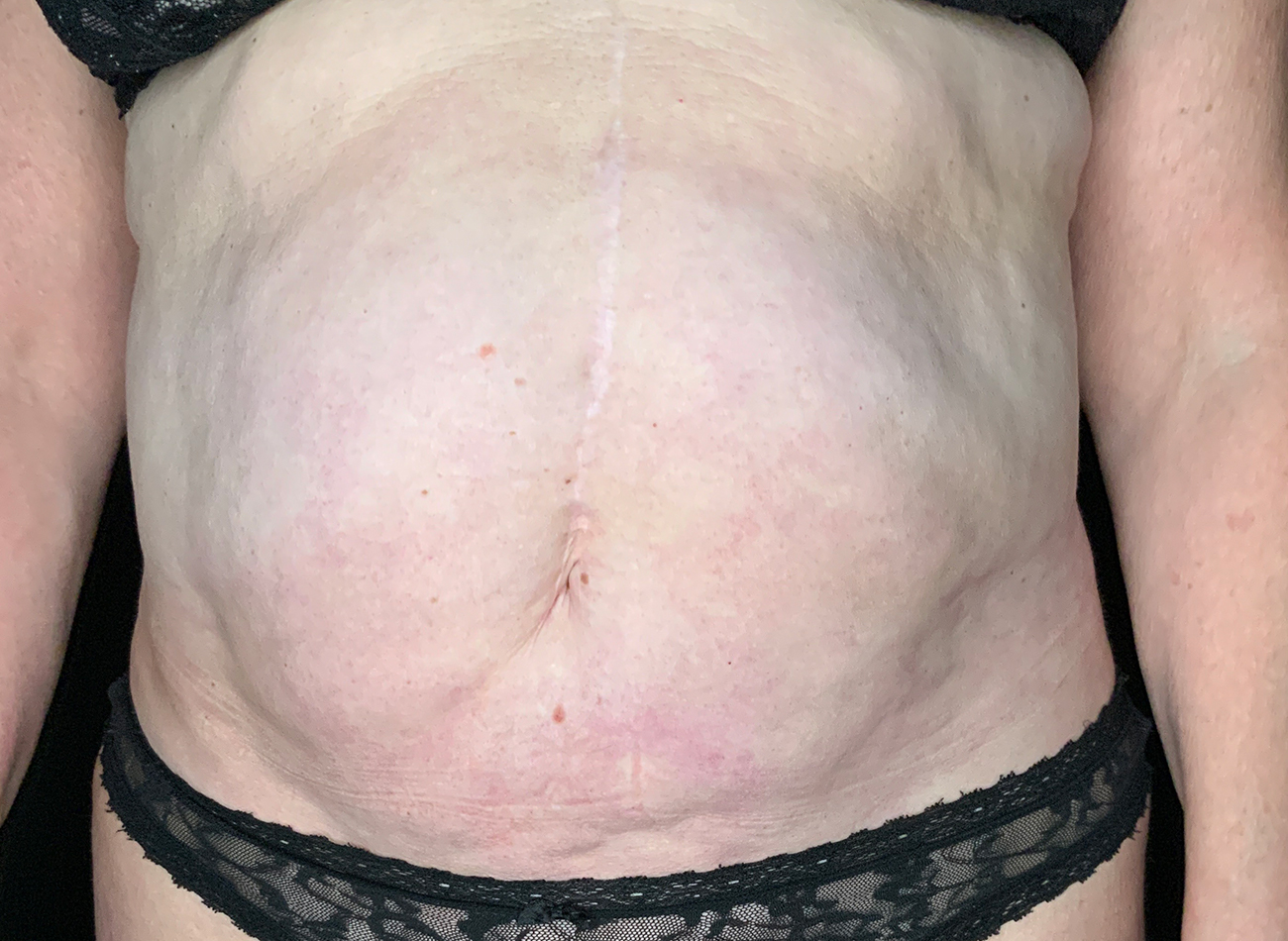 Patient #49717: Liposuction Before Image